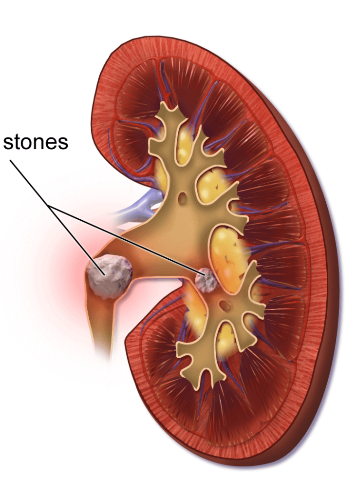 treatment for kidney stones