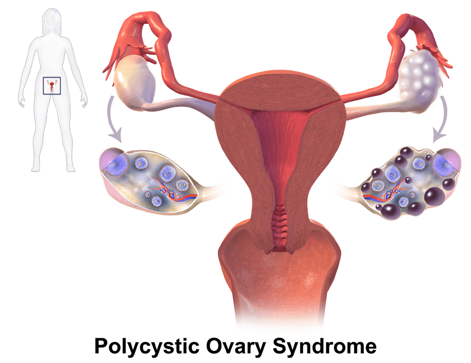 best doctor for pcos in dhaka