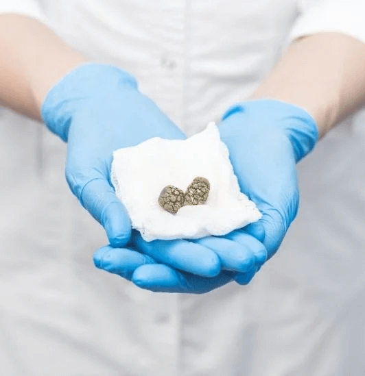 gallbladder stones treatment