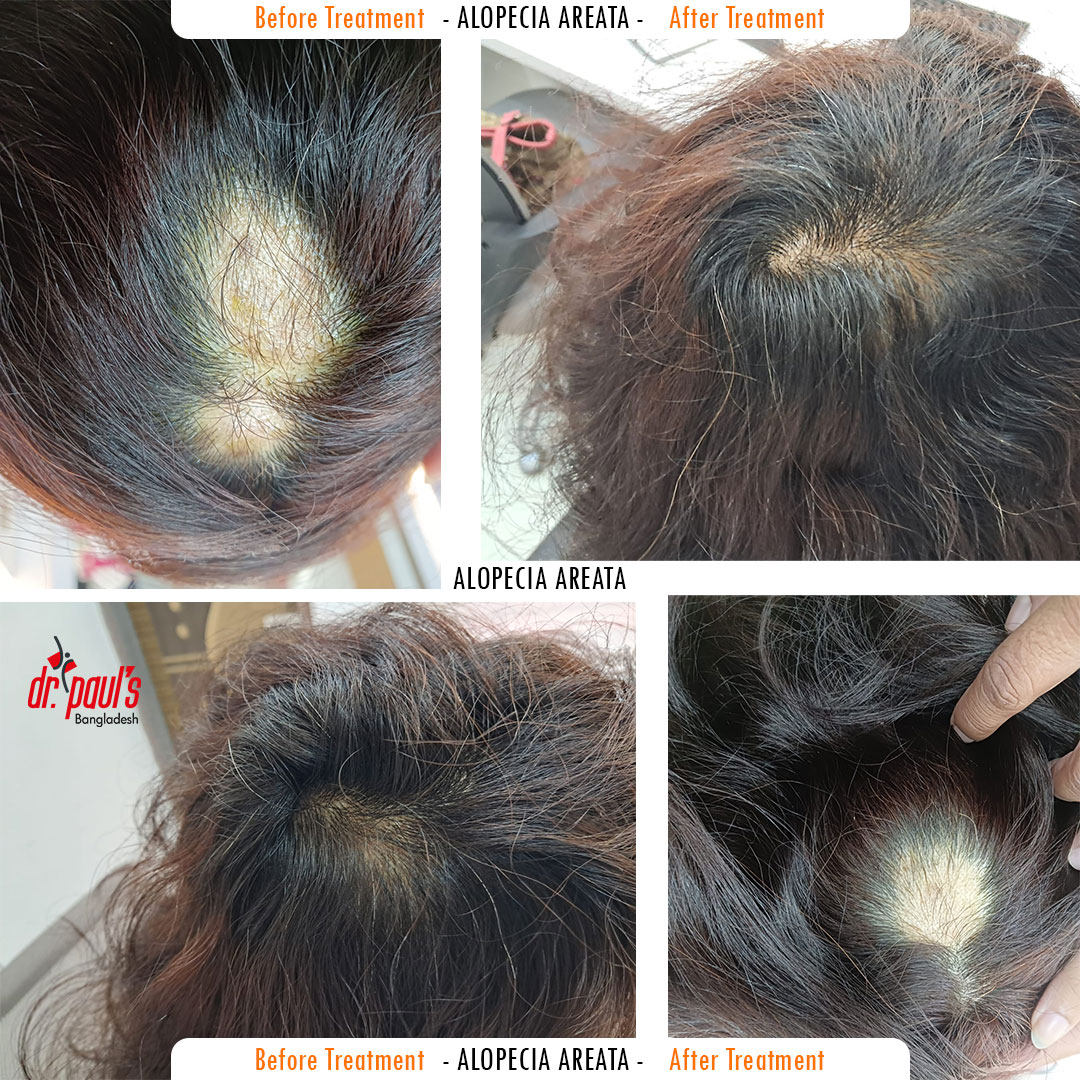 Alopecia areata treatment result