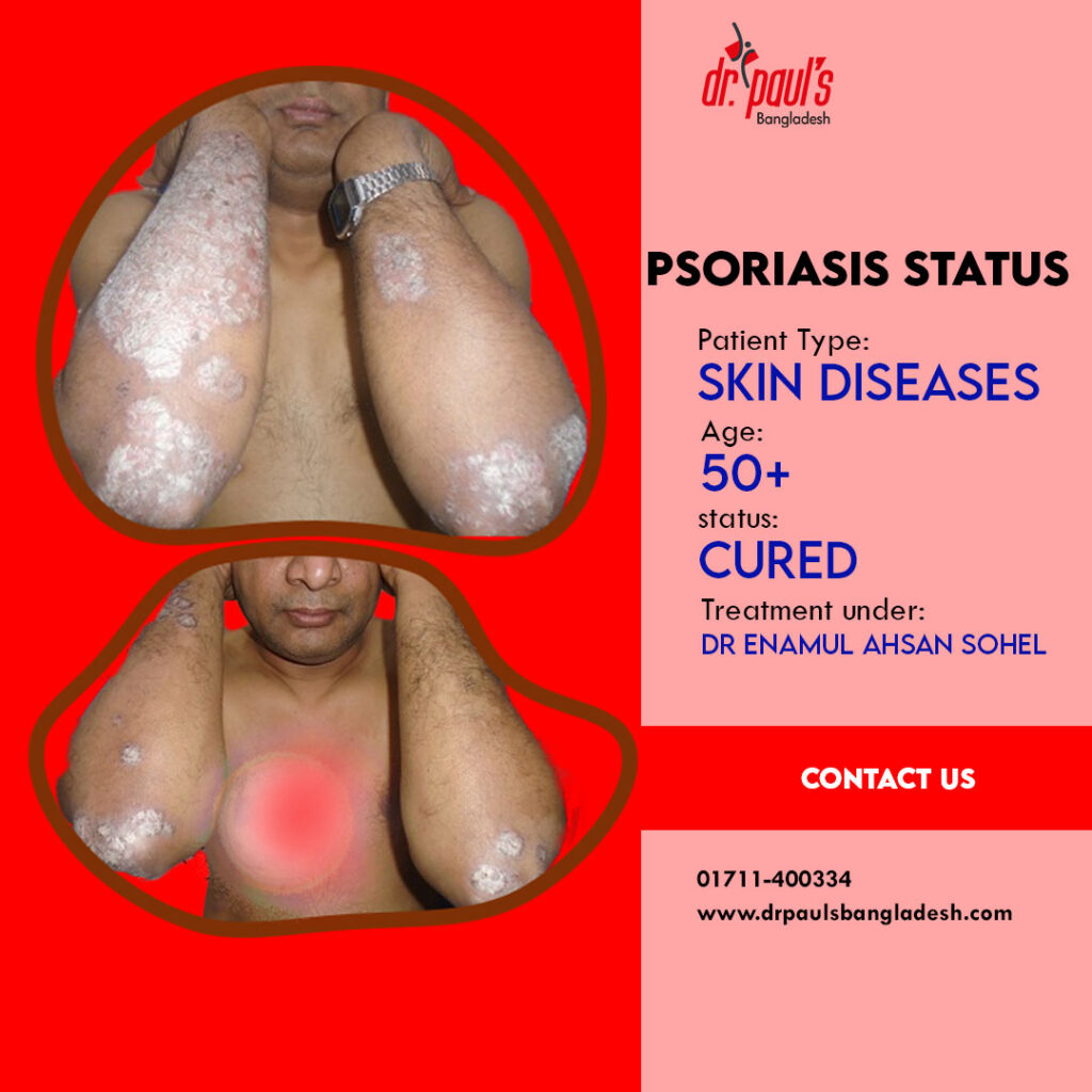 Psoriasis treatment