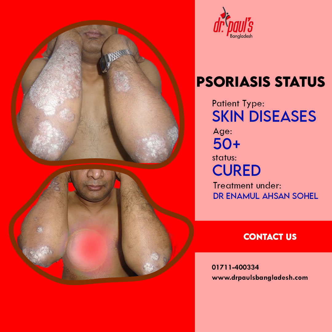 Psoriasis treatment