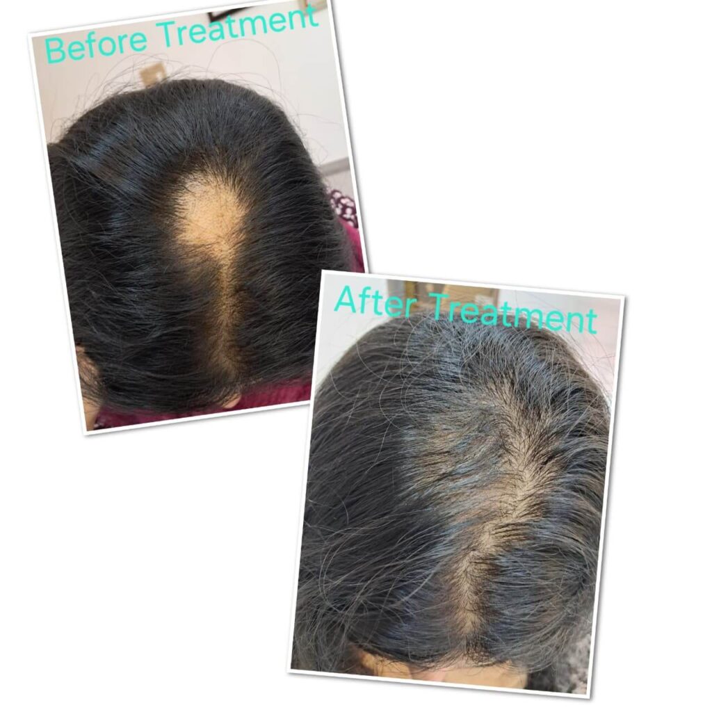 alopecia treatment before- after