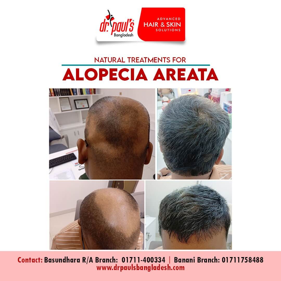alopecia treatment