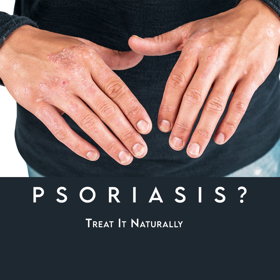 psoriasis treatment